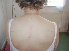 Example of needling